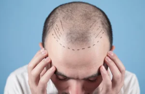 ¿Cuánto cuesta un trasplante de pelo en Barcelona? Cuánto cuesta un trasplante de pelo en Barcelona
