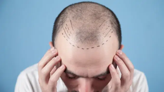 Cuánto cuesta un trasplante de pelo en Barcelona Cuánto cuesta un trasplante de pelo en Barcelona